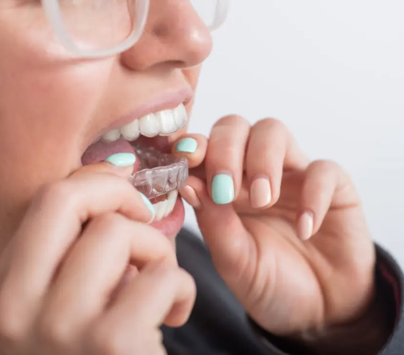 woman inserting clear aligner