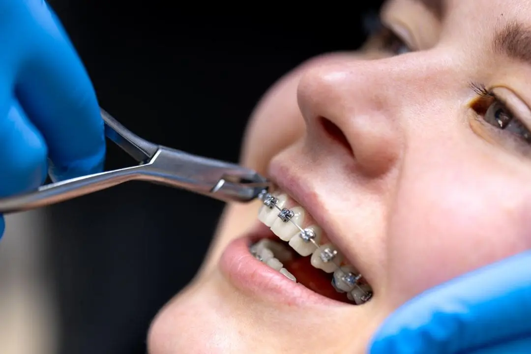palatal expanders