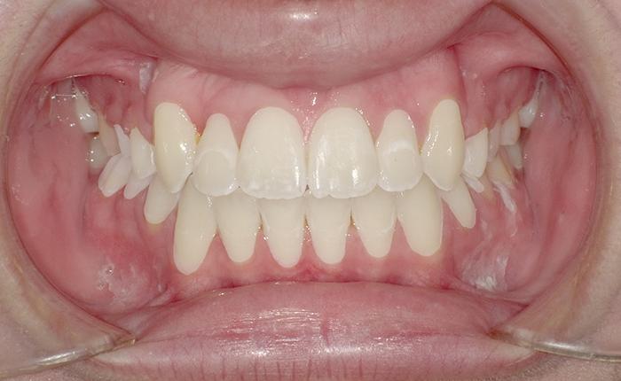 After Orthodontic Treatment - Gia Orthodontics